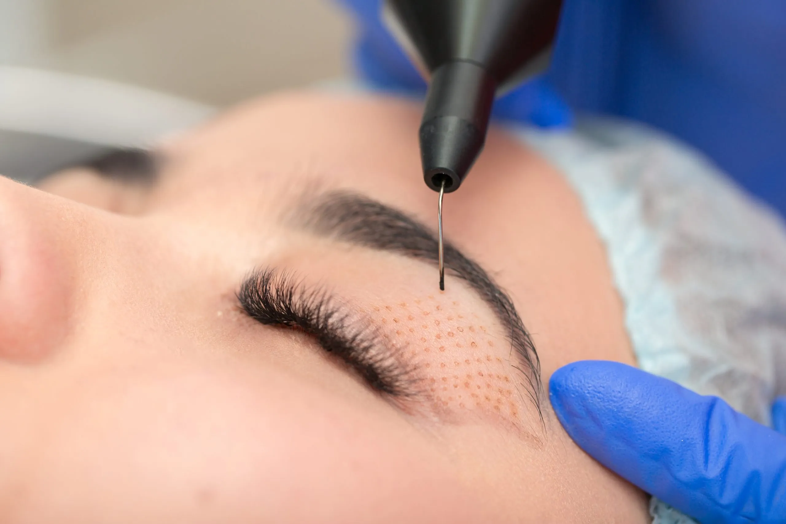 Tratamiento de blefaroplastia con láser Plasma IQ