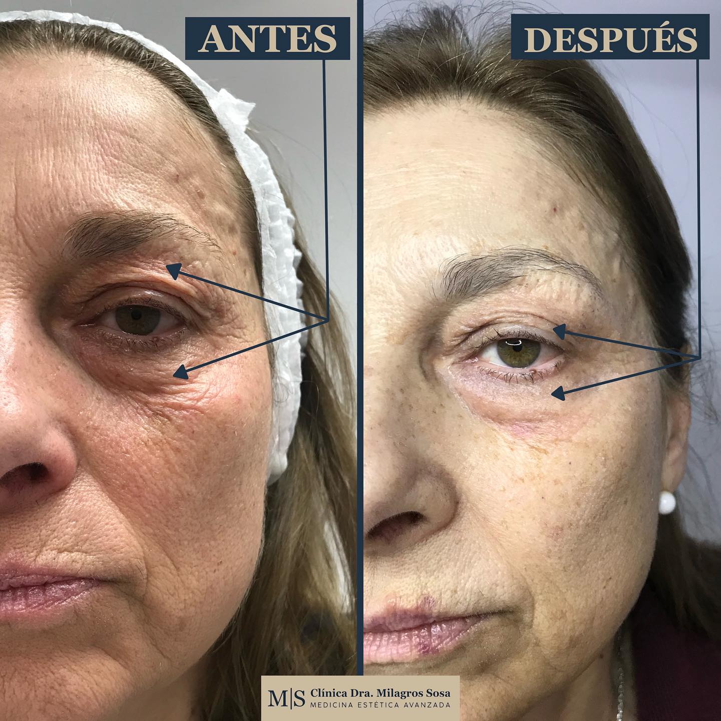 Blefaroplastia