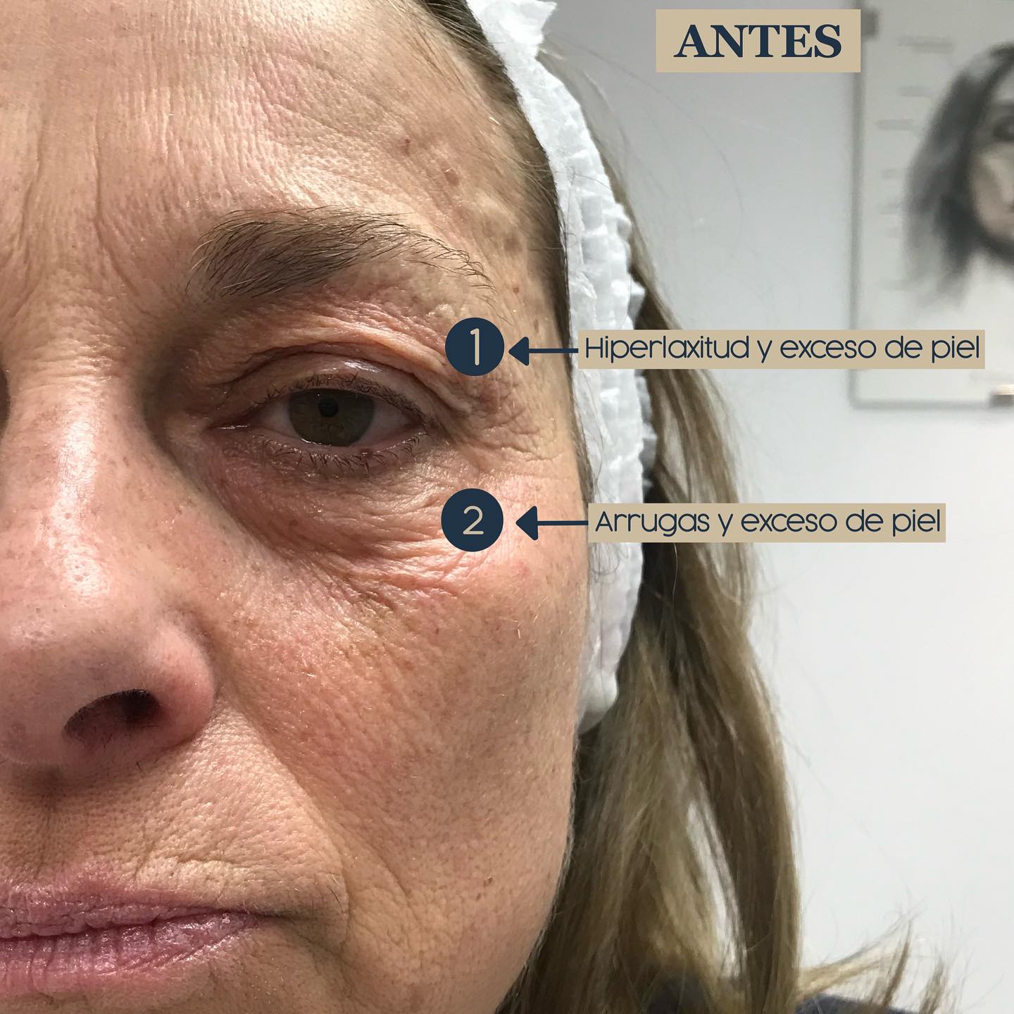 Blefaroplastia