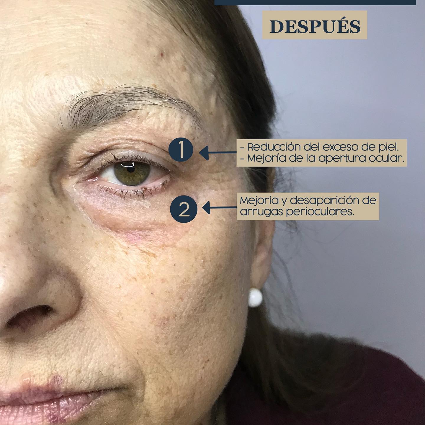 Blefaroplastia