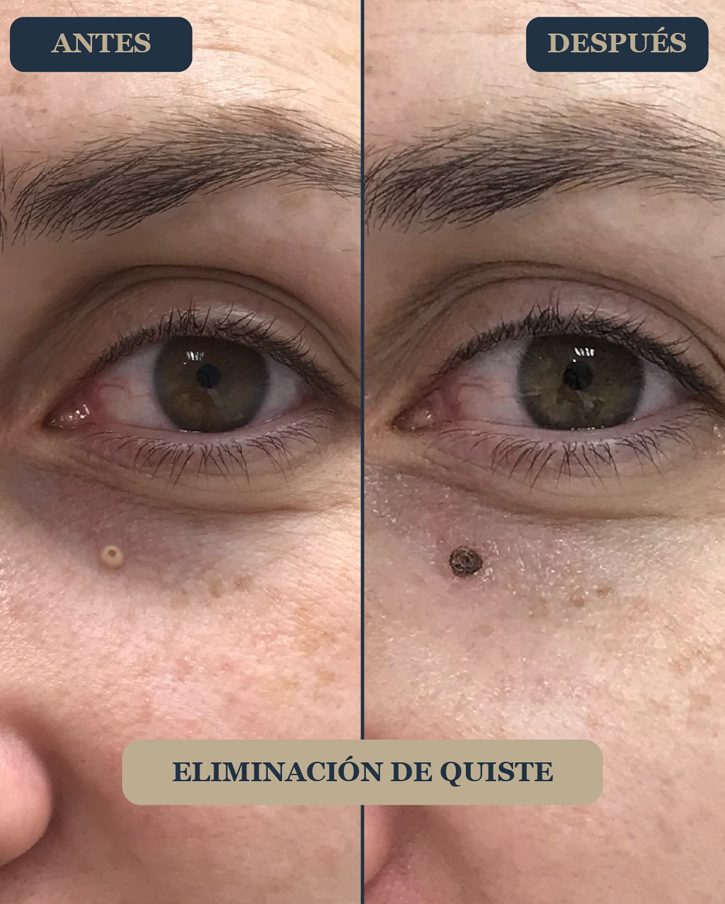 Eliminacion de Verrugas