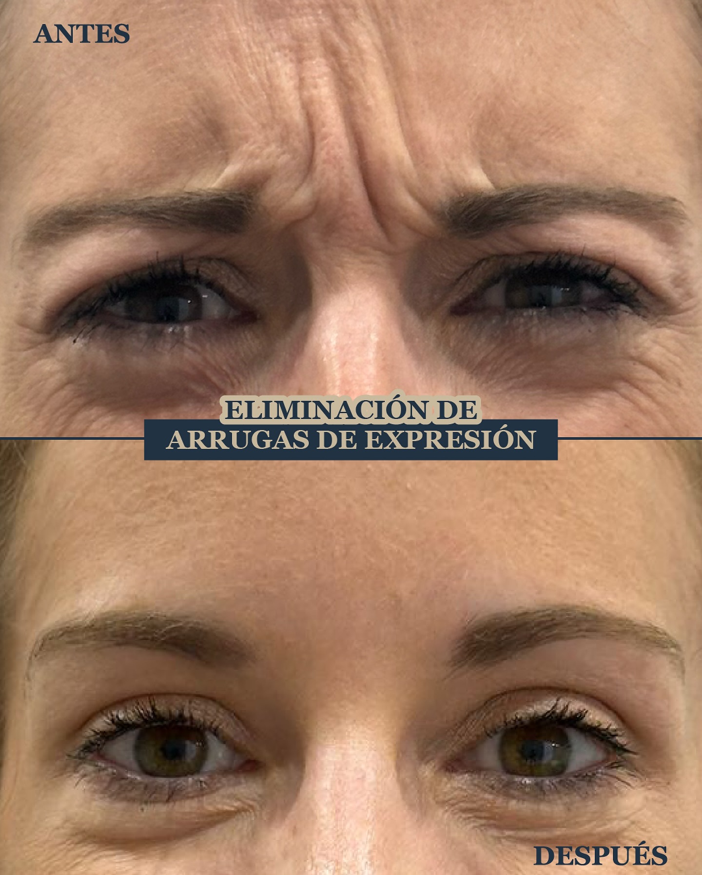 patas-de-gallo-entrecejo-y-frente