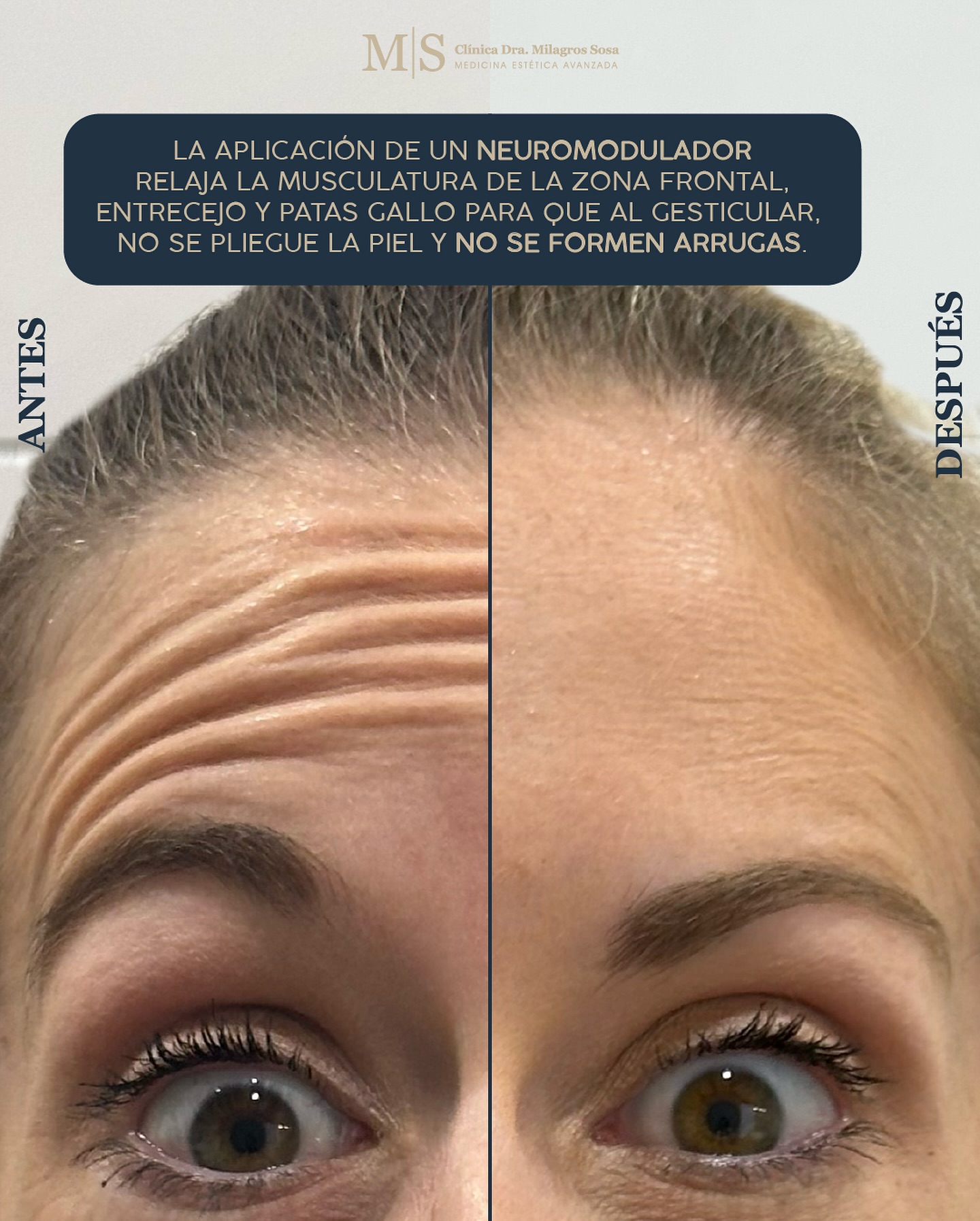 patas-de-gallo-entrecejo-y-frente