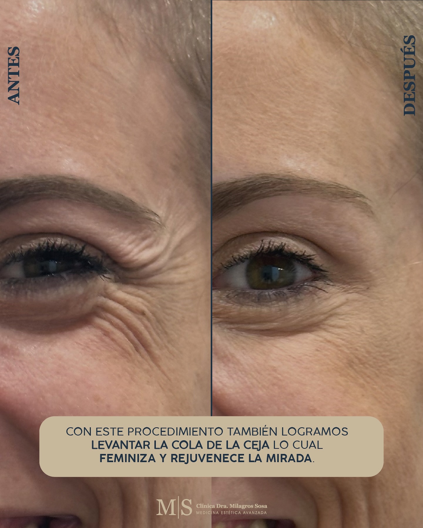 patas-de-gallo-entrecejo-y-frente