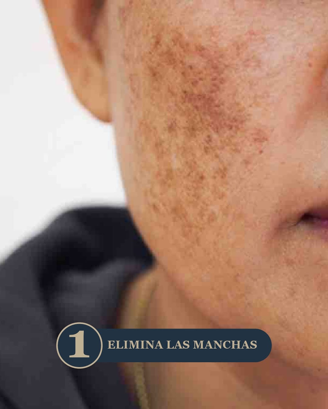 Peeling Quimico Facial