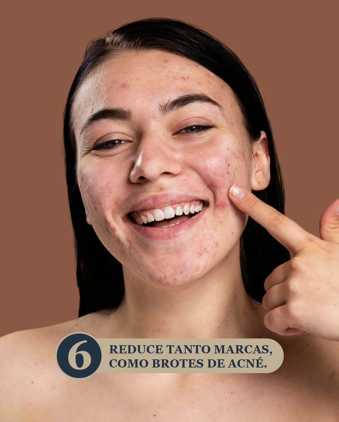 Peeling Quimico Facial