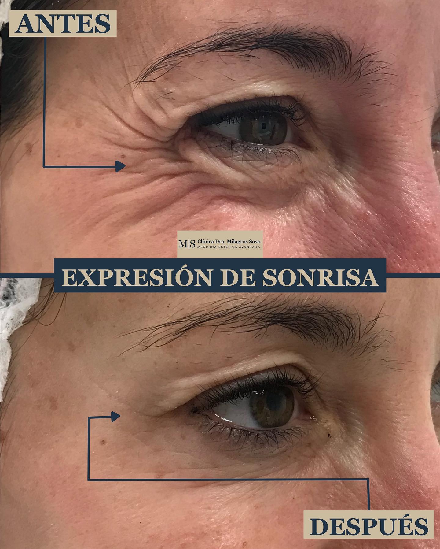 Tratamientos Antiarrugas