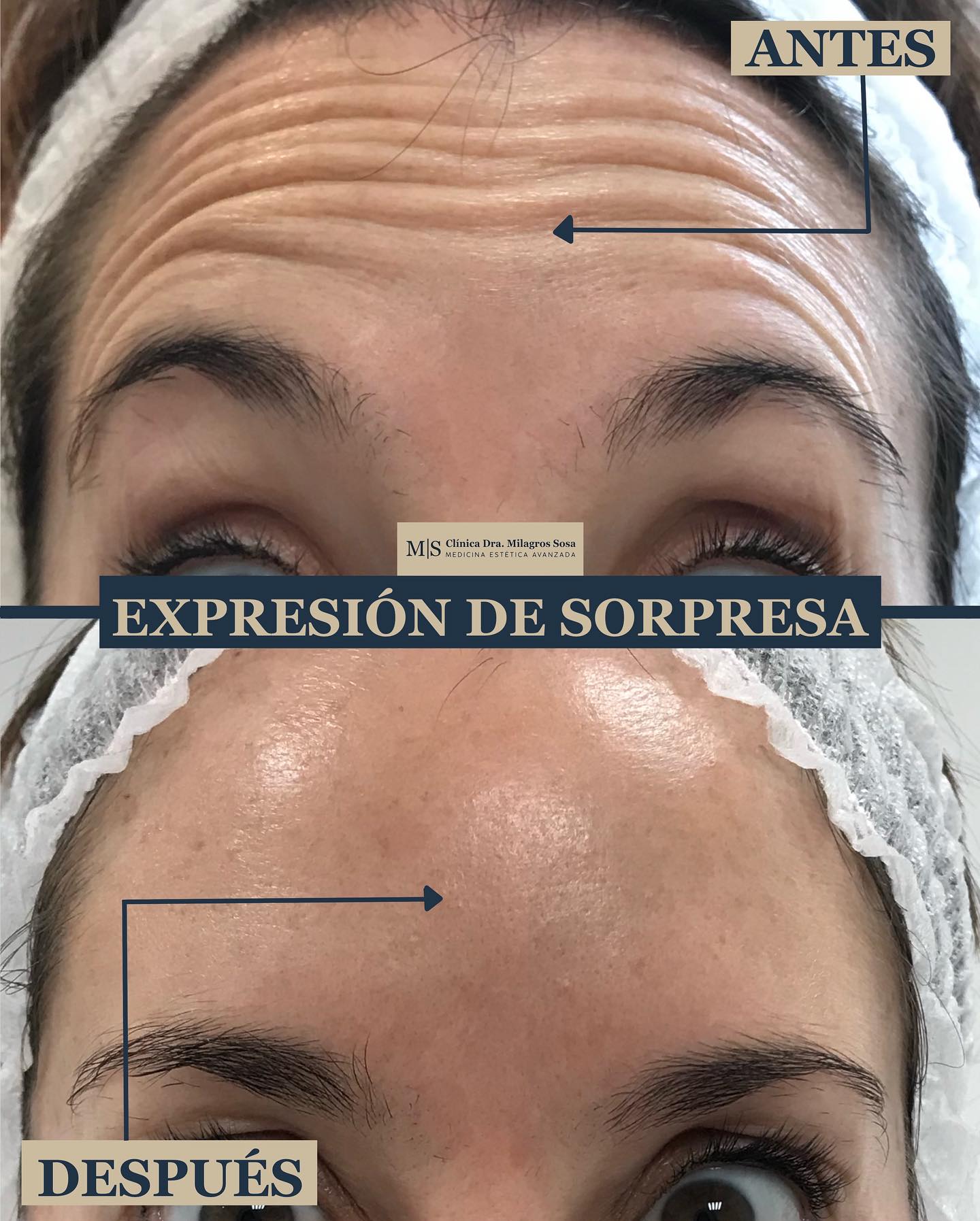 Tratamientos Antiarrugas