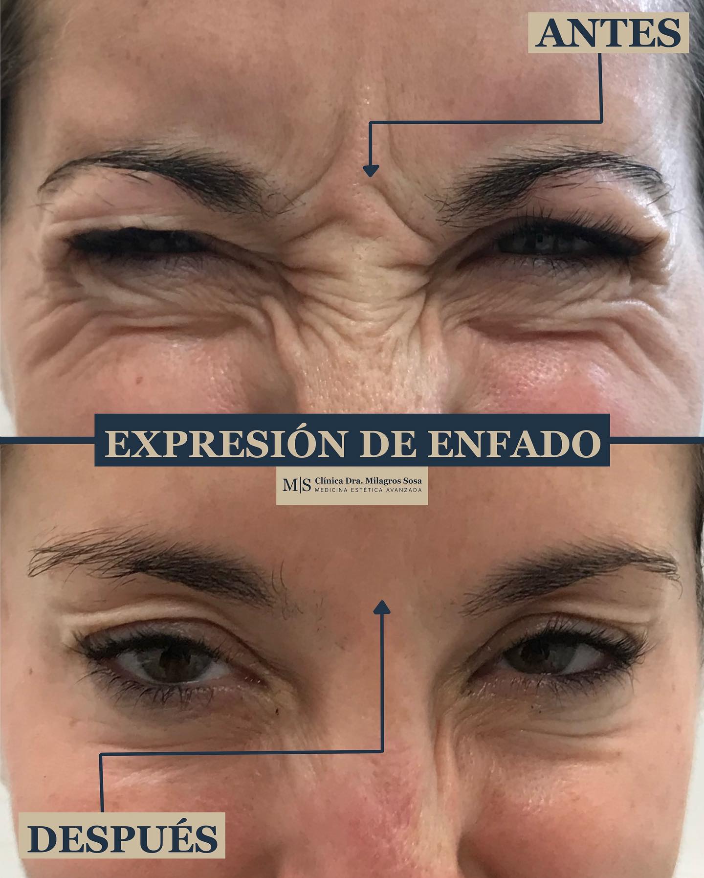 Tratamientos Antiarrugas